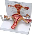 Female Uterus Anatomy Model showing common pathologies